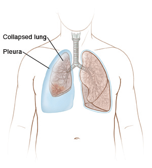 Outline of man showing collapsed lung inside pleura on right side. Normal lung on left.