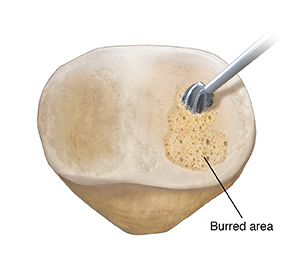Back view of patella showing instrument burring damaged cartilage.