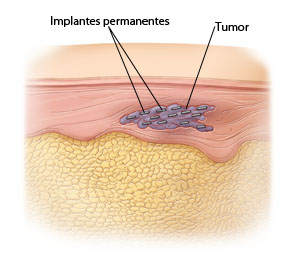 Corte transversal de la piel donde se ve un tumor con 13 pequeños gránulos en su interior.